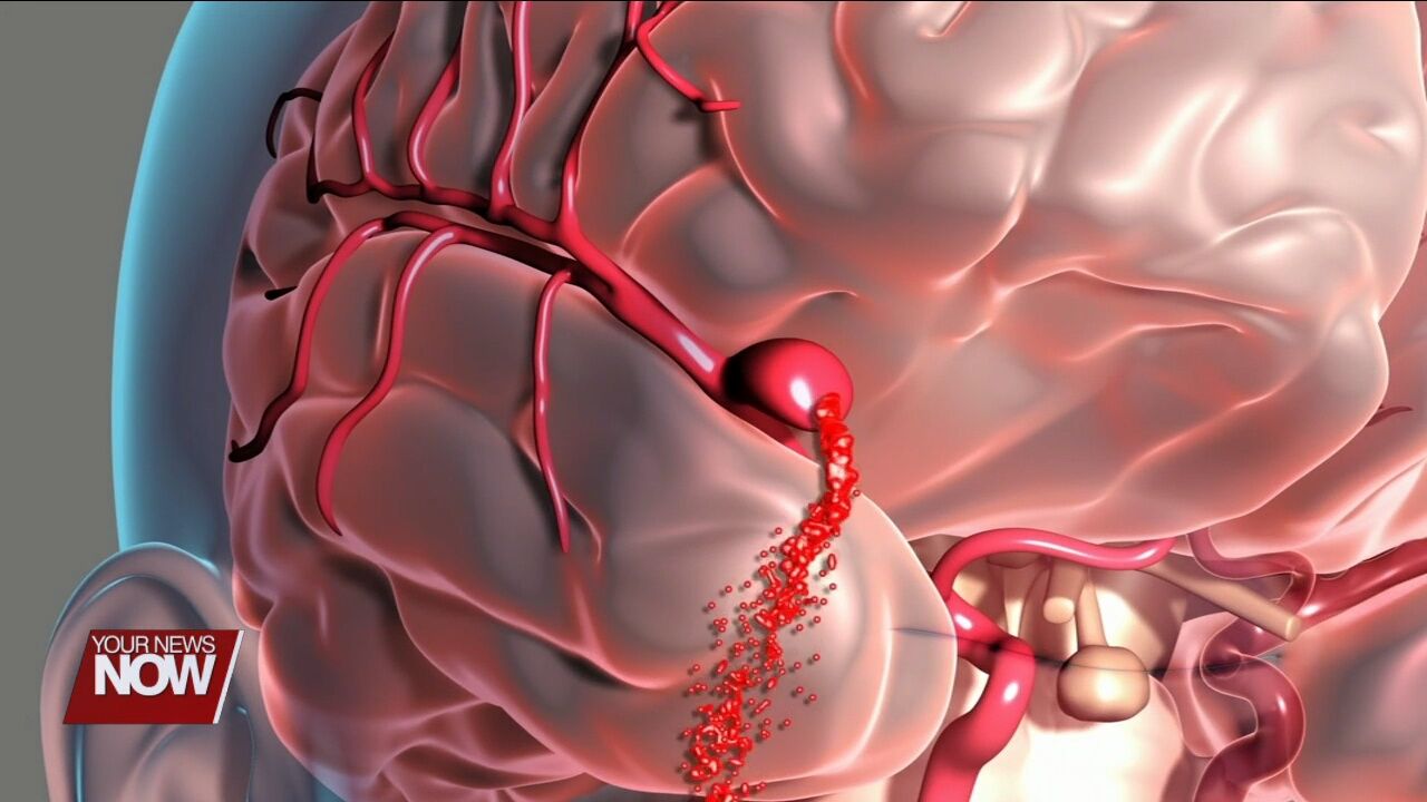 Brain Surgery through Eyelid Cures Woman’s Aneurysm